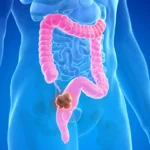 080423_mr_colorectal_cancer_feat