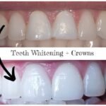 Teeth+Whitening+Minneapolis